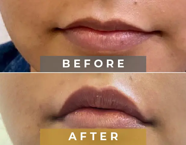 lip Filler Treatment in Gurgaon, Delhi