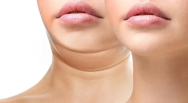 Best Double Chin Removal Treatment in Gurgaon, Delhi