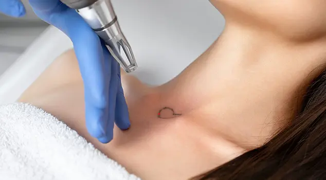 Best Laser Tattoo Removal Treatment in Gurgaon, Delhi