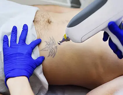 Laser Tattoo Removal Treatment in Gurgaon