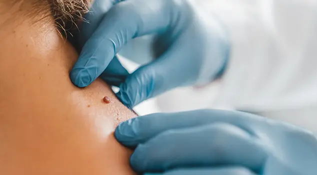 Best Mole, Warts and Skin Tags Removal Treatment in Gurgaon, Delhi